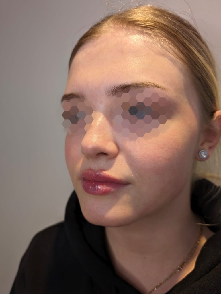 Lip filler Kettering, another result by Renaisskin