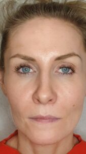 Renaisskin profhilo treatments kettering