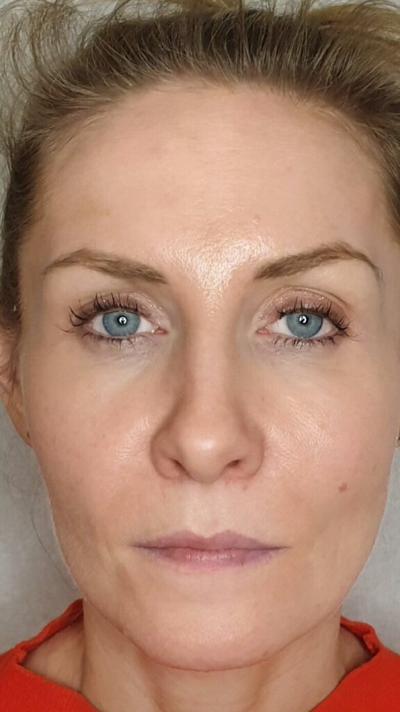 Renaisskin profhilo treatments kettering
