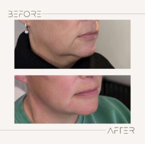 Before and after treatment at Renaisskin medical aesthetics clinic, showcasing natural skin or facial features enhanced with subtle and natural beauty improvements for a refreshed, rejuvenated look